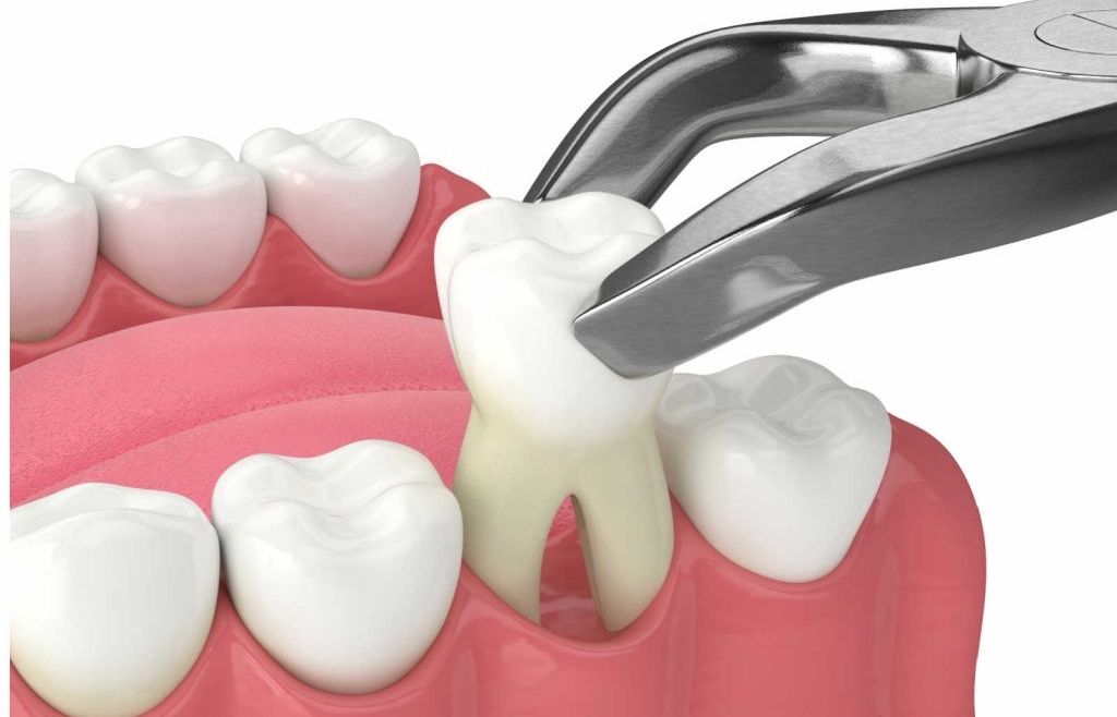 Extractions