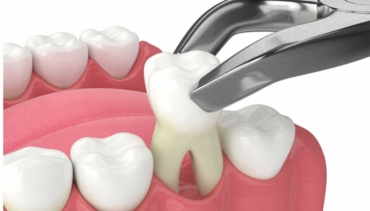 Extractions
