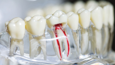 Root Canal Therapy