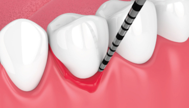 Gum Disease Treatment
